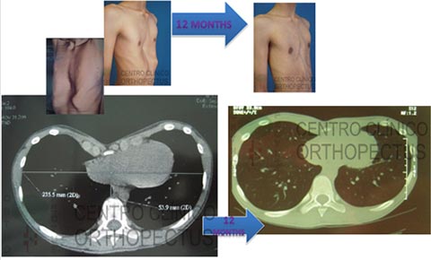 Orthopectus-Dynamic-Remodeling-Method-Transformation